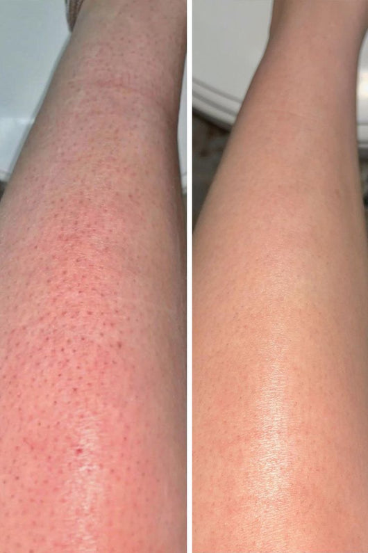 Cyperus Rotundus Serum