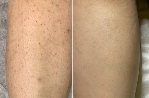 Cyperus Rotundus Serum