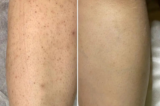 Cyperus Rotundus Serum